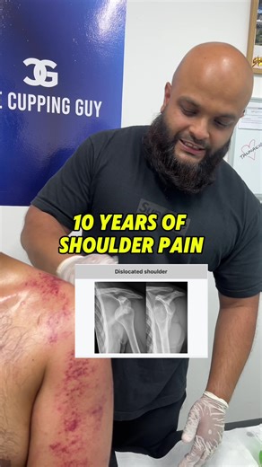 The Cupping Guy (@thecuppingguy)’s videos with original sound - The Cupping Guy