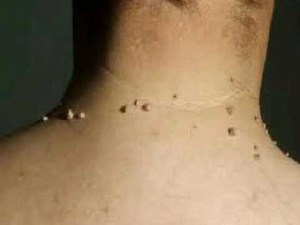 3 remèdes naturels pour éliminer les acrochordons