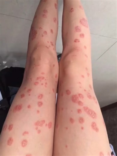 Effective Psoriasis Management and Community Support