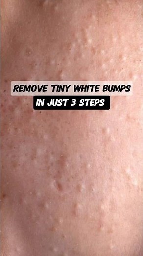 Remove Tiny White Bumps In 3 Steps #tinybumps #skincare #viral
