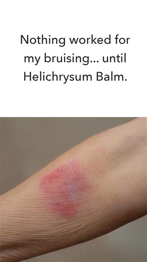 "Helichrysum balm is the best product I’ve found for reducing and recovering from purpura and bruising on the hands and arms. It also helps reduce the appearance of varicose and spider veins in the legs and ankles. I was taking 1/4 cup of olive oil a day, even bathing in it to reduce the ugly purple marks on my hands and arms. Helichrysum works fast and leaves skin feeling soft, supple and hydrated. I had seen 2 doctors about the purpura problem neither of which had a solution. After starting He