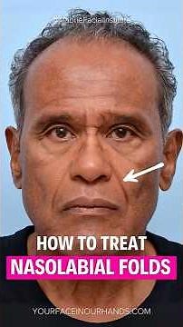 How to treat Smile Lines / Nasolabial Folds