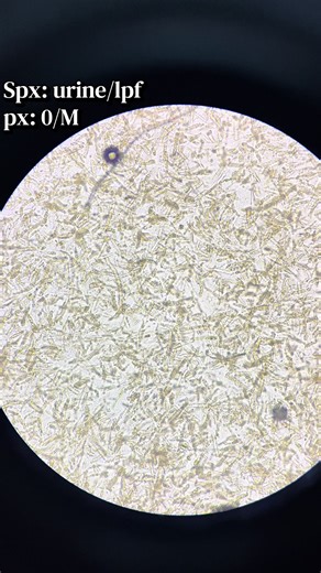 Urine Analysis: Understanding Spx & Px Readings