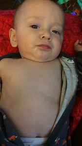 RSV Example - Retractions and nasal flaring