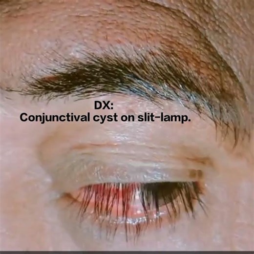Conjunctival cyst #optometrylife #eyediseases #optometry #eyecareexcellence #eyes #science #eyetest