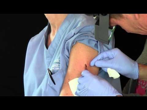 Dr.Timothy Jochen Explains the Punch Biopsy Technique | Palm Springs | Palm Desert