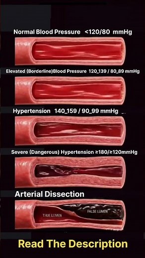 5 Stages of Blood Pressure Explained!