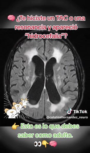 Hidrocefalia en adultos: síntomas y diagnóstico