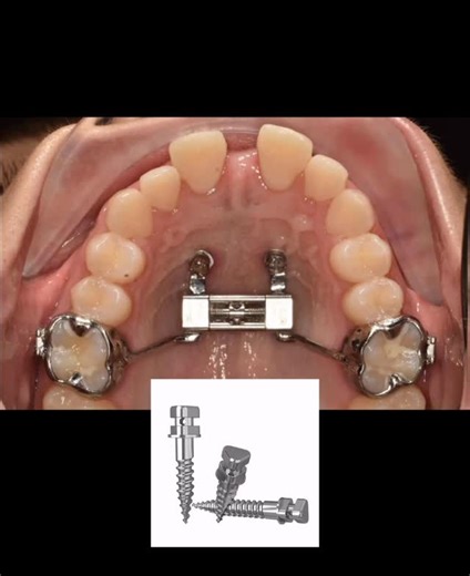 ‎Dr. Mo Almuzian (د. محمد احمد المزين) ♾️‎ | Miniscrew length in MARPE: more basal expansion… but not necessarily more “airway gain”. This is the key clinical takeaway from Dr Choi... | Instagram
