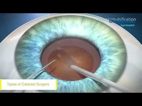 Types of Cataract Surgery Explained | Dr. Jatinder Singh Jaiswal