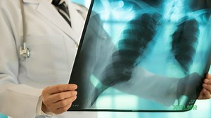 What is a pulmonary embolism?