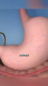 Gastric Bypass Surgery
