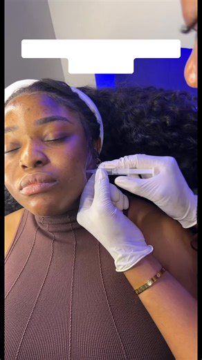 This is one of our most sought after treatments using #Botox to relax the masseter muscles to create a slimmer and more feminine face #medspainbenincity #aestheticclinic #masseterbotox #facialslimming #facelift