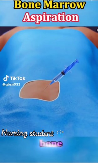 Bone Marrow Aspiration Procedure Explained