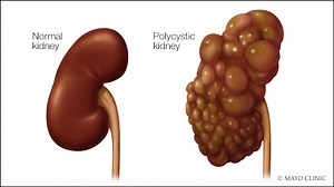 Mayo Clinic Minute: Using AI to predict kidney failure in patients with polycystic kidney disease - Mayo Clinic News Network