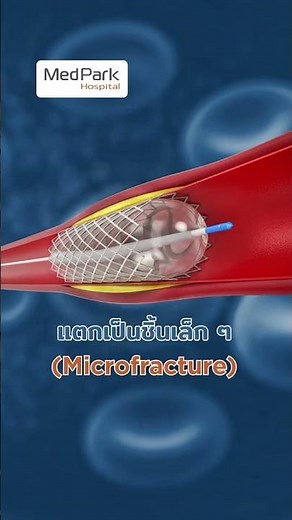 การทำบอลลูนหัวใจ IVL รักษาหลอดเลือดหัวใจตีบซับซ้อน #โรคหัวใจ #หลอดเลือดหัวใจตีบ #บอลลูนหัวใจ