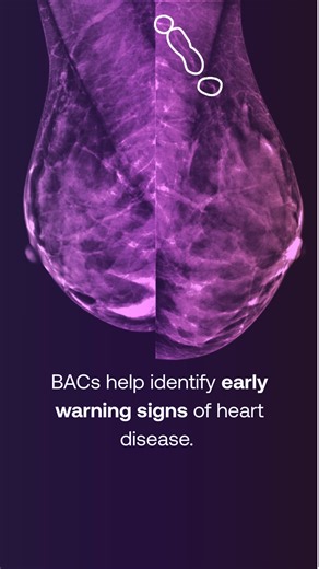 As many as 40% of women who receive a mammogram have Breast Arterial Calcification (BAC) present. 🔍 Here’s why that matters: BAC is a significant risk enhancer for heart disease — the leading cause of death for women in the U.S. For years, this important information often went unreported because it isn’t cancer. SimonMed’s Mammogram Heart uses advanced technology to help close that gap. It analyzes the BAC already visible on your mammogram to provide a personalized Heart Health Report, with: ✅ 