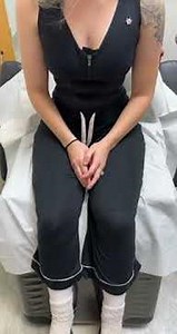 1 DAY AFTER A TRANSUMBILICAL BREAST AUGMENTATION (TUSBA) BY DR GABRIEL PATINO 04 25 2023.5105257999