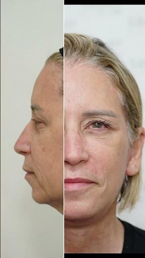 Deep Plane Facelift & Neck Lift | Before and After