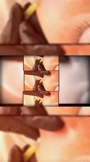 Before and After Gone Wrong Celebrity Surgery Stories Explained | #hollywoodbuzz #cosmeticsurgery