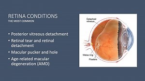 VIDEO: Demystifying Retinal Diseases