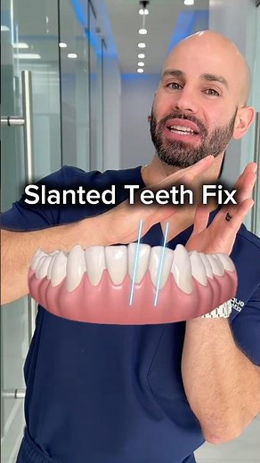 Fixing slanted adult lower front teeth with Invisalign ￼