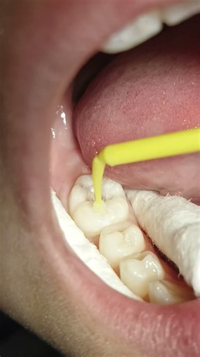 Treatment of dental caries #dentist #caries #dental #shorts