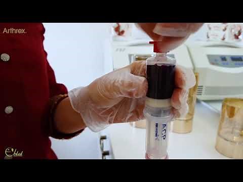 Eblal - Arthrex Acp PRP