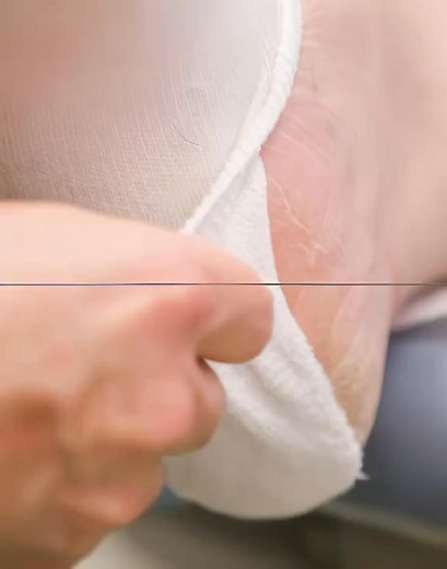 #pimplepopper #drpimplepoppers #cyst #cystremoval #pimplepopping #cyst #cystremoval #pimplepopping #skincareroutine #blackheadremoval #satisfyingvideos | pimple treatment