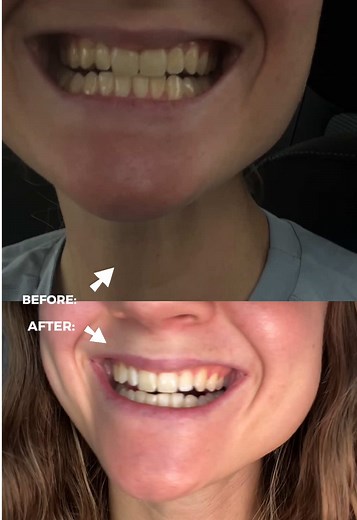 Testing POPS Whitening Strips for Seven Days