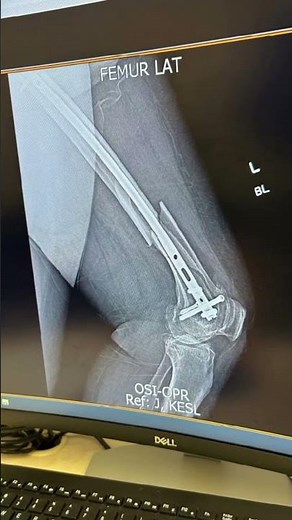 Femur Fracture Recovery || Tibia Fibula Femur & Other Fracture Recovery