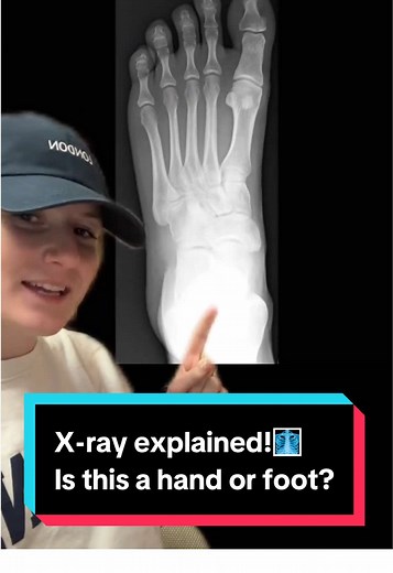 Identifying Hand or Foot from X-ray: Bone Landmarks Revealed