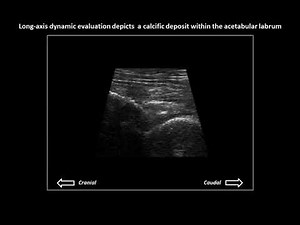 Acetabular labral calcification on hip ultrasound