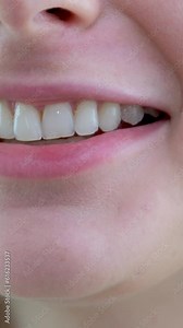 Close-up of a smiling woman in a transparent plastic bleaching tray. Removable retainer for perfectly straight teeth. Widescreen. Young woman with beautiful smile, closeup. Teeth whitening