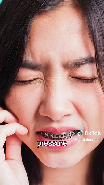 Why Damon Braces Don't Have Bands