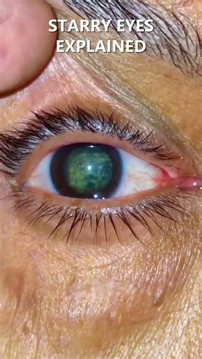 Unlocking the Mystery of Starry Eyes: What They Really Mean
