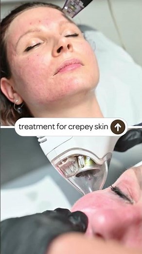 Conscious of crepey skin? Tixel or Morpheus8 could help!