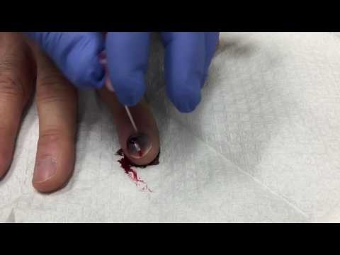 SUBUNGAL HEMATOMA, **NEEDLE? WHERE?*** OUCH! DR. Mike Lewis, MD