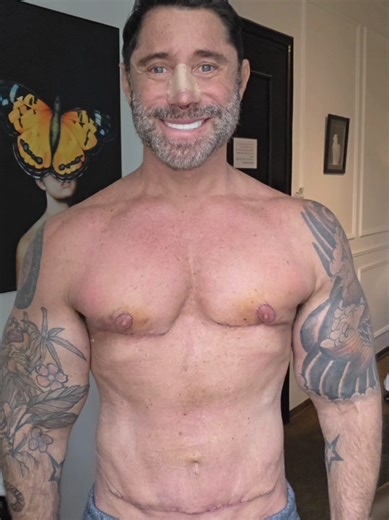 Day 6 Transformation After Gynecomastia Surgery