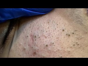 Say Goodbye to Pimples: The Remedies Dermatologists Recommend