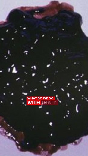 Understanding Black Tar Stool: Signs of GI Bleeding Explained