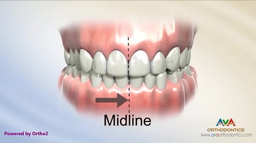 How to Fix a Functional Shift in the Upper Jaw