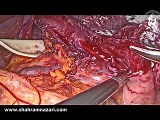 Long Myotomy for Achalasia • Video • MEDtube.net