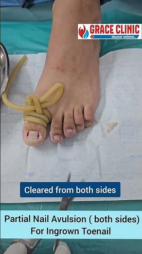 partial Nail Avulsion surgery for Ingrown Toenail | Nail surgery Grace clinic Dehradun