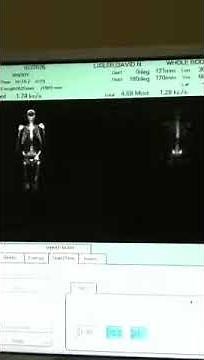 Whole Body Nuclear Bone Scan