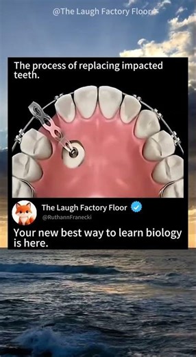 🦷This is how 😬 hidden teeth are replaced | MDCT