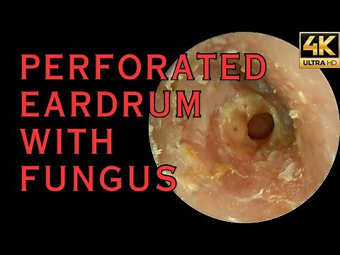 Perforated Eardrum With Recurrent Infection (4K 60FPS)