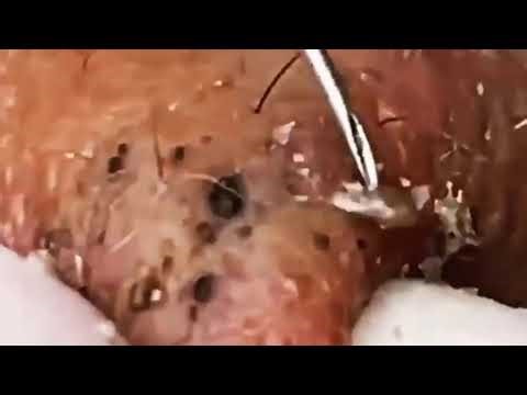 【角栓除去】しぶとい！大量のニキビを芯出しするのって気持ちいい／Blackhead Removal Show #acne #002 @0544 @0283