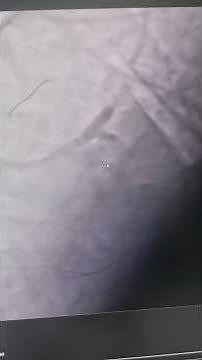 culotte bifurcation stenting technique