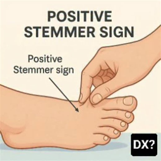 RK NURSE'S HUB | The Stemmer sign is a clinical examination technique used to diagnose lymphedema by attempting to pinch and lift the skin on the dorsal... | Instagram